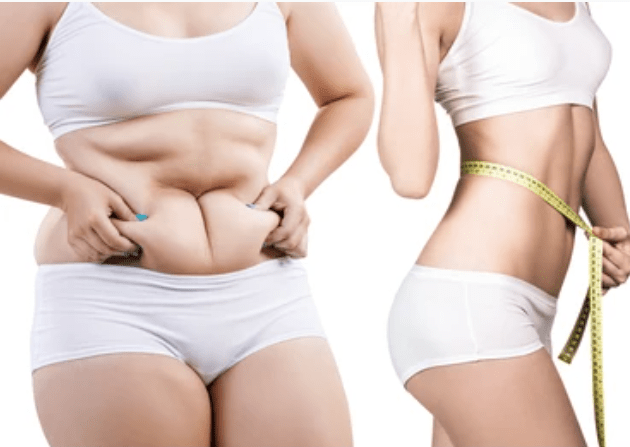 عملية تجميد الدهون | التنحيف بتجميد الدهون