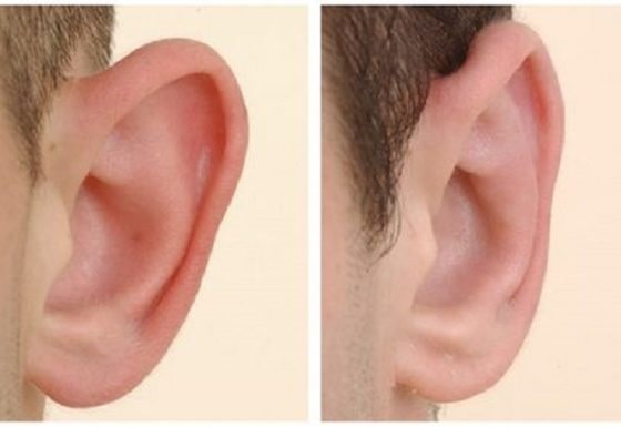 عملية تصغير الأذن