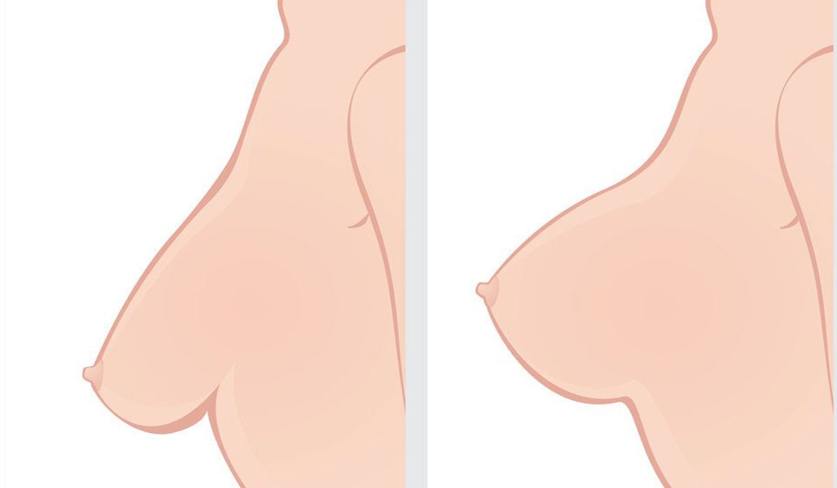 عملية-رفع-الثدي-2.jpg