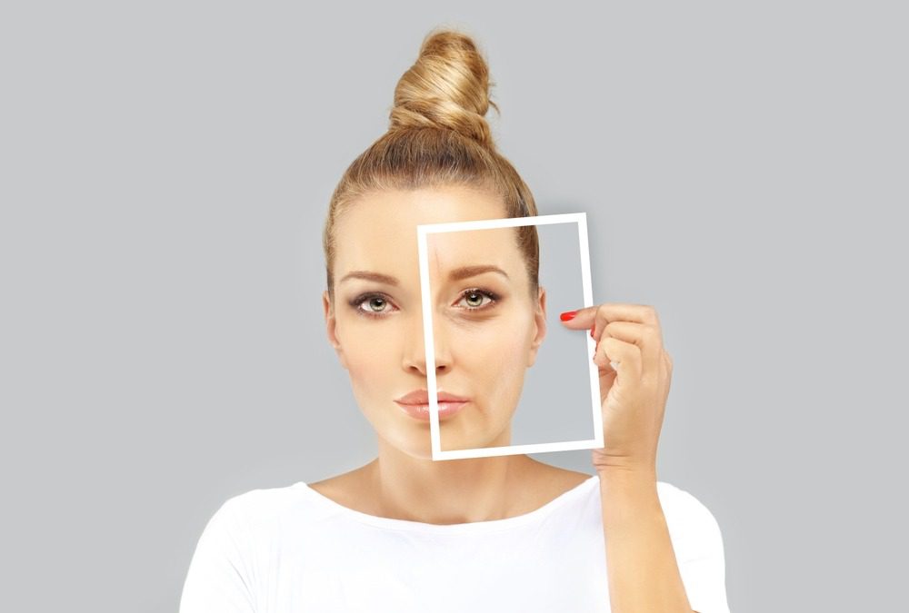 Botox under the eyes 1 بوتوكس تحت العين
