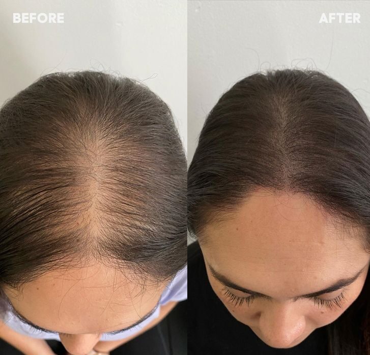 سعر زراعة الشعر