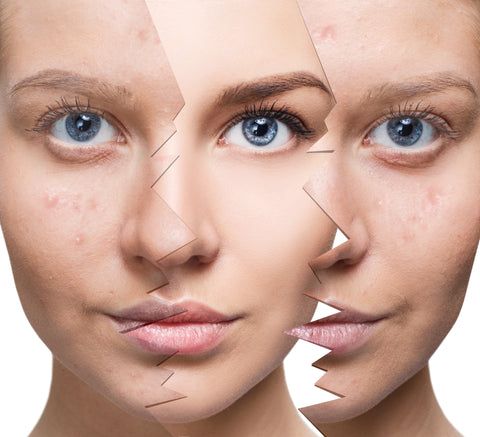 اسعار التقشير الكيميائي 1 جلسات التقشير الكيميائي للبشرة