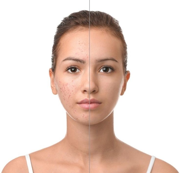 اسعار التقشير الكيميائي 2 جلسات التقشير الكيميائي للبشرة